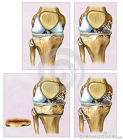 Descriptive illustration an Osteotomy or correction of the knee where the femur and tibia appear crooked. Cartoon Illustration