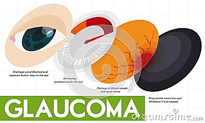 Descriptive Infographic Showing Some Stages of Glaucoma Disease, Vector Illustration Vector Illustration