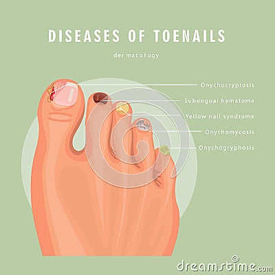 Deseases of toenails vector medicine card. Colorful design. Detailed image with text. Vector Illustration