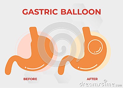 Stomach Endoscopy Gastric Balloon Inside a Stomach weight loss surgery vector illustration obesity Vector Illustration