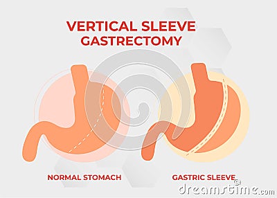 Laparoscopic Sleeve Gastrectomy, Vertical Gastrectomy, Weight loss surgery Vector Illustration of Stomach reduction surgery Vector Illustration