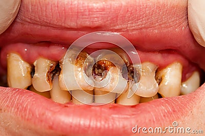 Destructed teeth Stock Photo