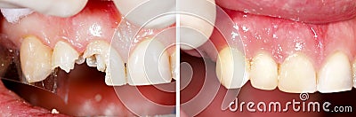 Destructed teeth filling Stock Photo