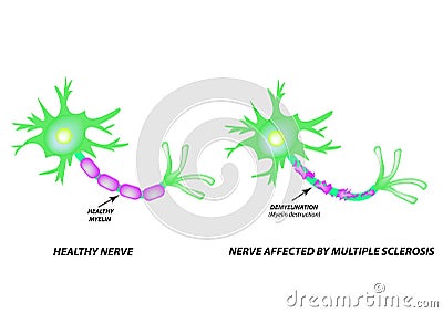 The destruction of the myelin sheath on the axon. Damaged myelin. Neuron affected by multiple sclerosis. World Multiple Vector Illustration