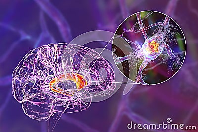 Destruction of neurons of the caudate nucleus, conceptual 3D illustration Cartoon Illustration