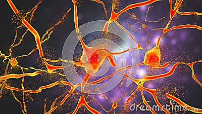 Destruction of neurons of Dorsal striatum, conceptual 3D illustration Cartoon Illustration