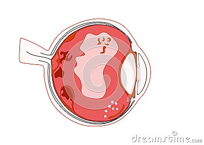 Destruction of the vitreous body Types of Floaters white blood cell deposits Fluid pockets vitreous strands Fragment of Vector Illustration