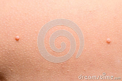 Detail of a molluscum contagiosum nodule produced by the Molluscipoxvirus virus on the skin of the abdomen of a child Stock Photo