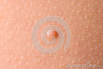 Detail of a molluscum contagiosum nodule produced by the Molluscipoxvirus virus on the skin of the abdomen of a child Stock Photo