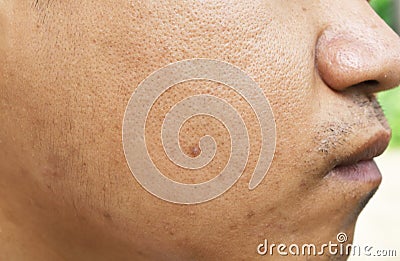 Pores and oily on surface young asian man face skin do not take care for a long time Stock Photo