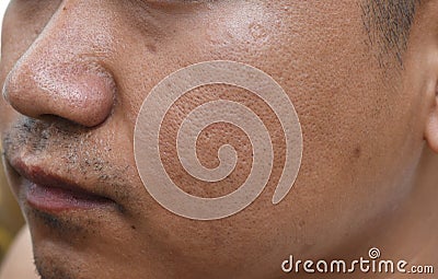 Pores and oily on surface young asian man face skin do not take care for a long time Stock Photo