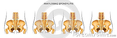 The development of ankylosing spondylitis in the lumbar spine Vector Illustration