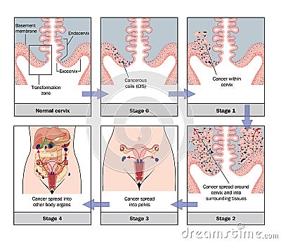 Development of cervical cancer Vector Illustration