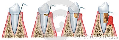 Development of periodontitis Stock Photo