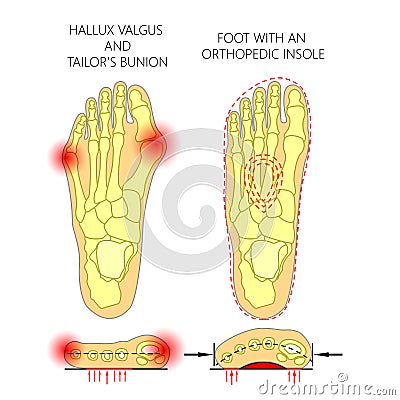 Deviation of the first and the fifth metatarsals transverse flat Vector Illustration