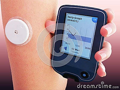 Device for continuous glucose monitoring of blood sugar levels â€“ CGM Stock Photo