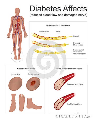 Diabetes affects the nerves and vessels. Stock Photo