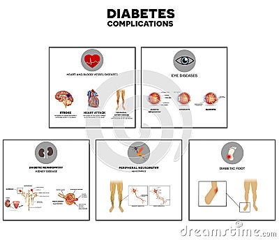 Diabetes complications Vector Illustration