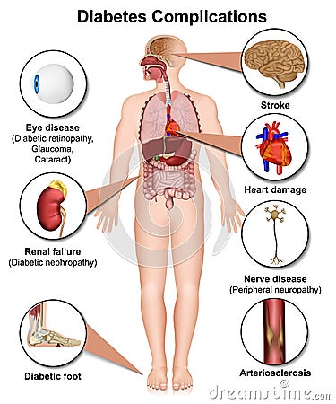 Diabetes complications and diseases medical 3d illustration on white background Cartoon Illustration