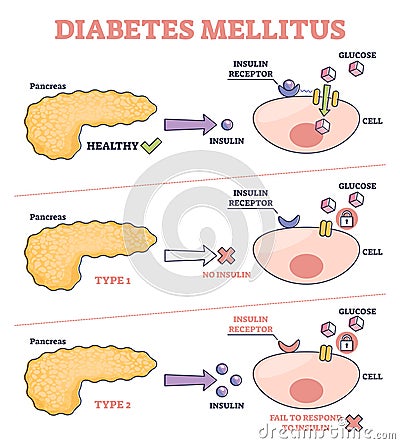 Diabetes mellitus as high blood sugar and metabolic illness outline diagram Vector Illustration