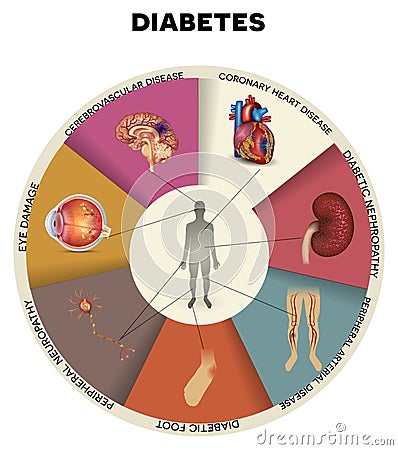 Diabetes mellitus info graphic Vector Illustration