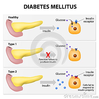 Diabetes mellitus Vector Illustration