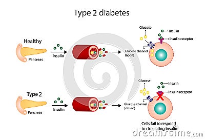 Diabetes mellitus type 2, cells fail to respond to insulin, Insulin resistance. high blood glucose levels. Cartoon Illustration