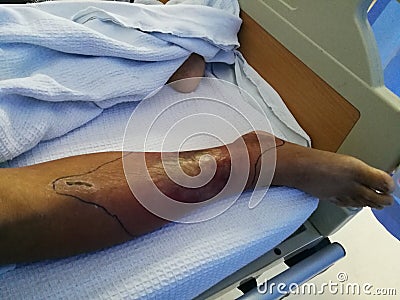 A diabetes patient resting on bed and with the leg swelling and redness symptoms. Stock Photo