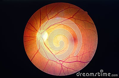 Diabetes retinopathy. Stock Photo