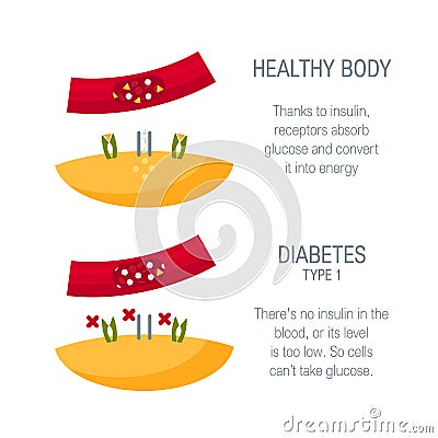 Diabetes type 1 concept in flat style, vector Cartoon Illustration