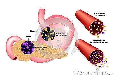 Diabetes Type Vector Illustration