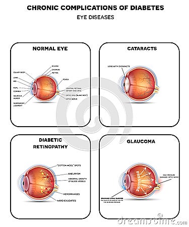 Diabetic Eye Diseases diagram Vector Illustration