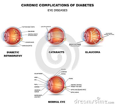 Diabetic Eye Diseases Vector Illustration