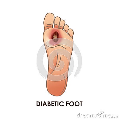 Diabetic Foot. Defeat, ulcer, skin sores on foot Stock Photo