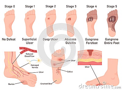 Diabetic foot diseases symptoms stage medical infographic healthcare poster vector illustration Vector Illustration