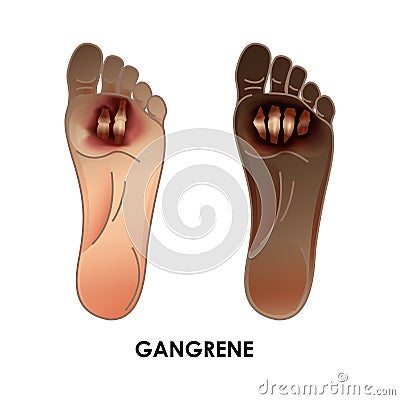 Diabetic Foot. Gangrene. Ulcers, skin sores on foot Cartoon Illustration