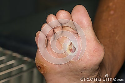 https://thumbs.dreamstime.com/x/diabetic-foot-infected-wound-58286613.jpg