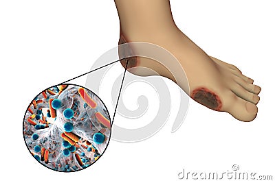 Diabetic foot infection with close-up view of bacteria Cartoon Illustration