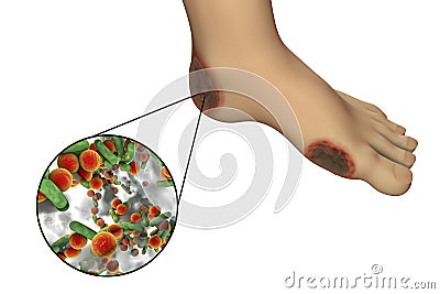 Diabetic foot infection with close-up view of bacteria Cartoon Illustration