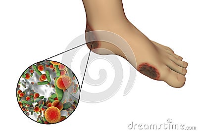 Diabetic foot infection with close-up view of bacteria Cartoon Illustration