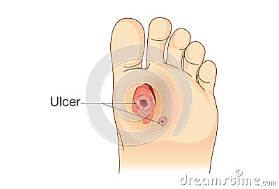 Diabetic Foot Pain and Ulcers. Vector Illustration