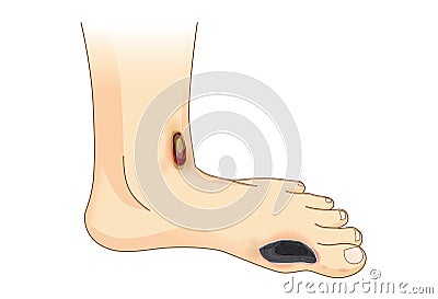 Diabetic Foot Pain and Ulcers. Vector Illustration