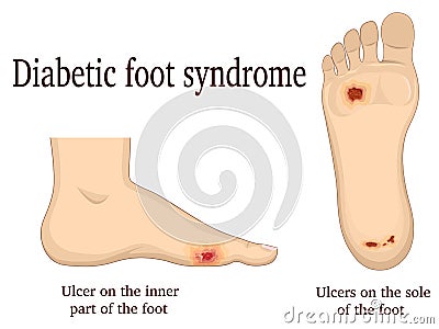 Diabetic foot syndrome Vector Illustration