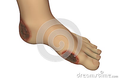 Diabetic foot ulcer Cartoon Illustration