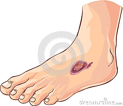 Diabetic foot Vector Illustration