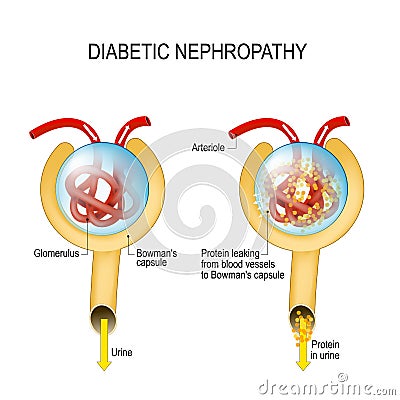 Diabetic nephropathy. diabetic kidney disease Vector Illustration