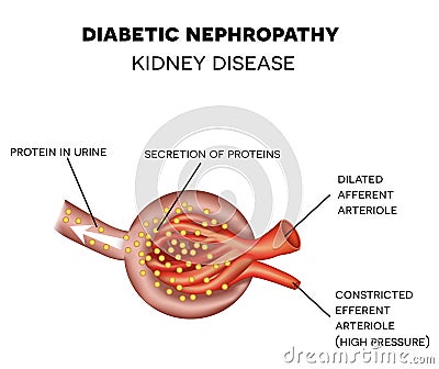 Diabetic Nephropathy, glomerulus anatomy Vector Illustration