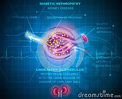Diabetic Nephropathy, kidney disease Vector Illustration