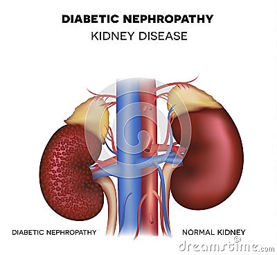 Diabetic Nephropathy, kidney disease Vector Illustration