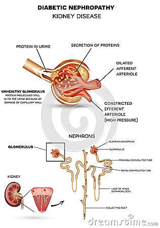 Diabetic Nephropathy, kidney disease Vector Illustration